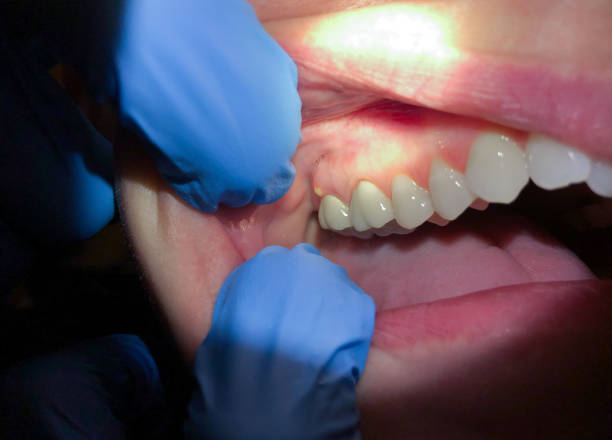 Best Urgent Tooth Repair  in Cottage Lake, WA